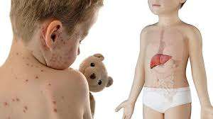 Reye Syndrome: Causes, Symptoms, Diagnosis and Treatments